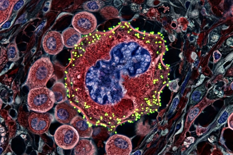 Quatre présentations sur douze : AstraZeneca s’impose dans le programme consacré au cancer à Madrid