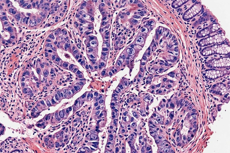 Pourquoi certains cancers colorectaux frappent-ils plus durement les jeunes ?